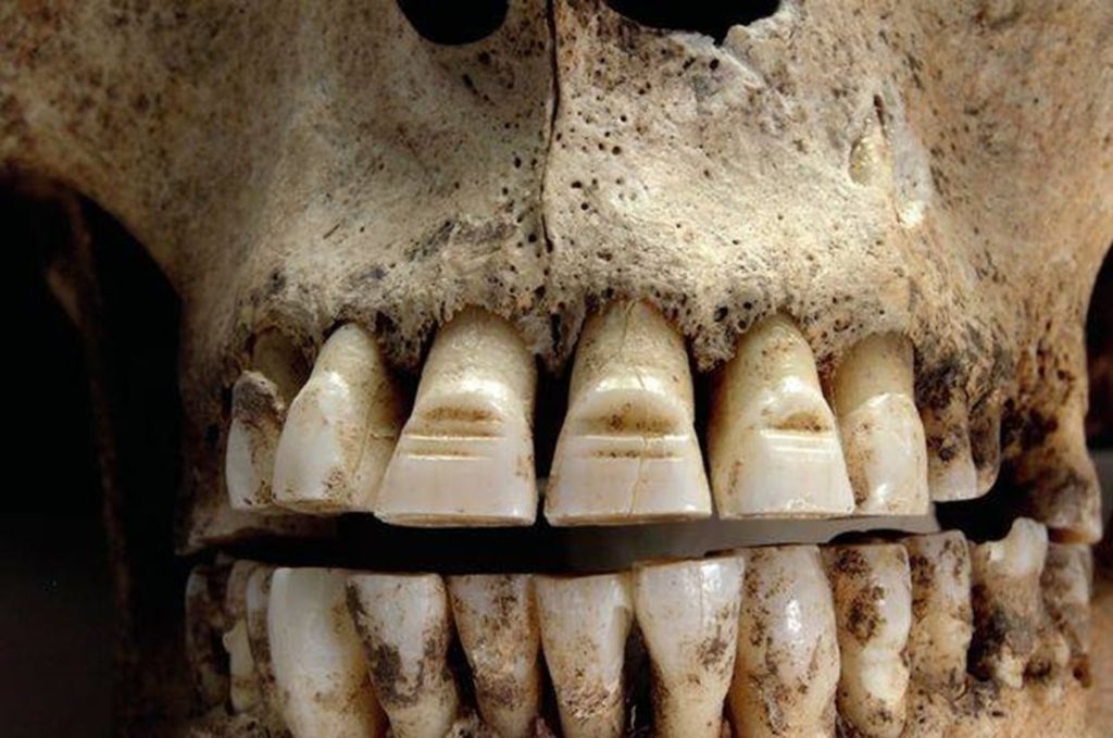 törpülenmiş dişler