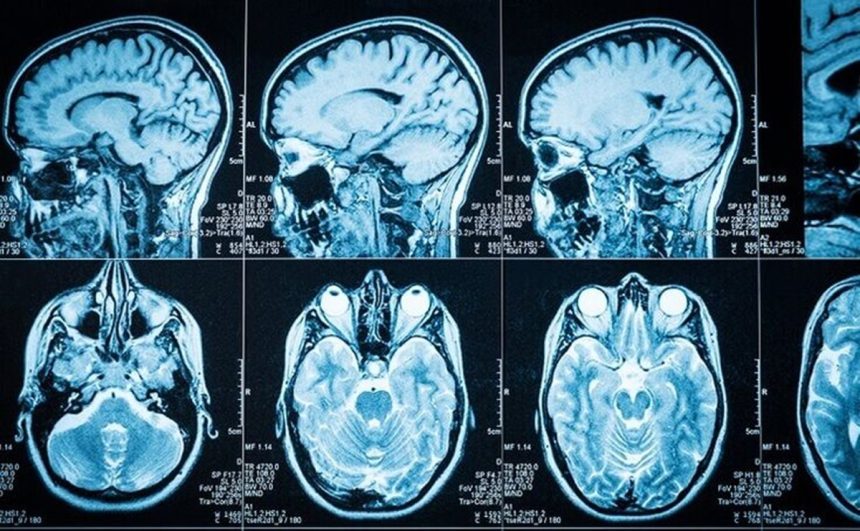 Alzheimer, beyin hücrelerinin ölümüne neden olan ve ilerleyici bir şekilde zihinsel ve fiziksel işlev kaybına yol açan nörodejeneratif bir hastalıktır.